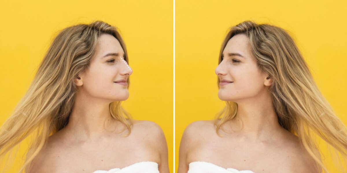 young-woman-before-after-rhinoplasty-medium-shot